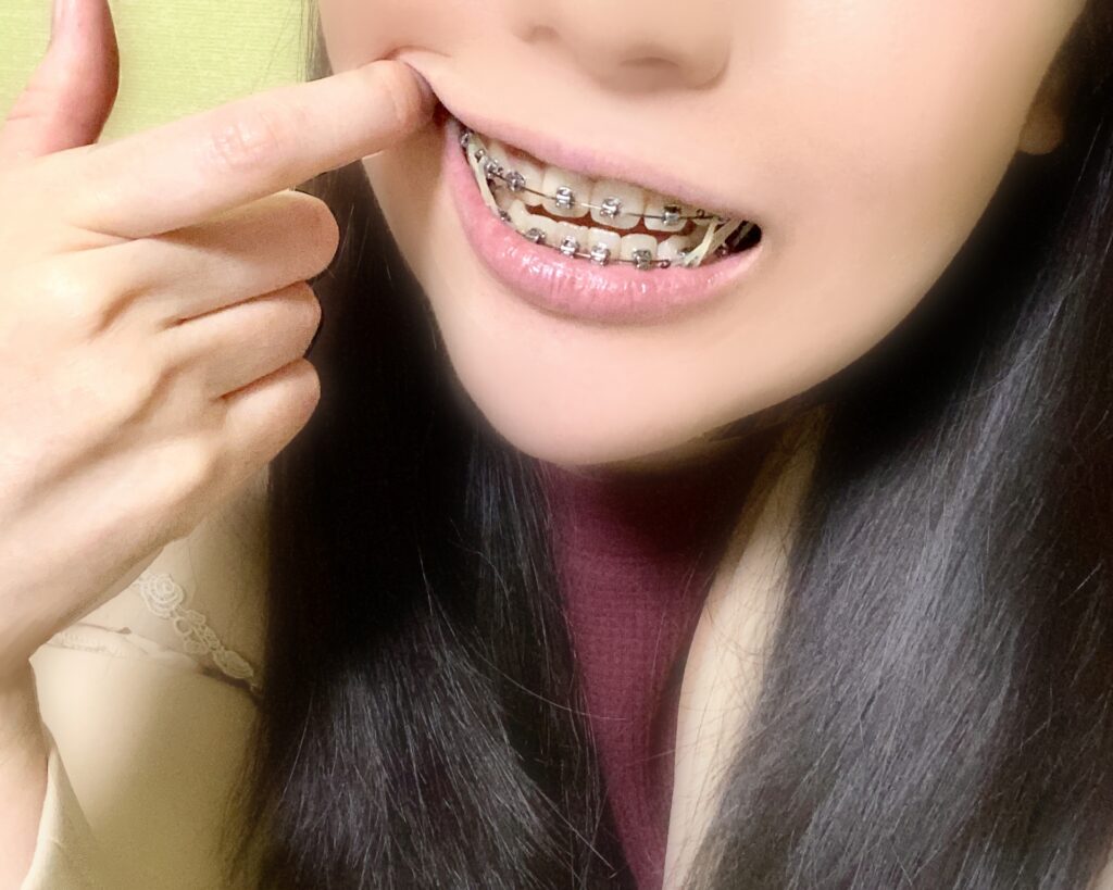 反対咬合 マウスピース S （GPのための成功する マウスピース矯正導入 