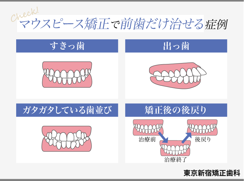 マウスピース矯正で前歯だけ治せる症例