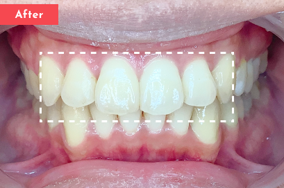 叢生治療後 - Oh my teeth マウスピース矯正Proプラン11ヶ月の症例 Case 22