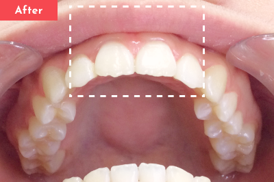 すきっ歯治療後 - Oh my teeth マウスピース矯正Basicプラン3ヶ月の症例 Case 29