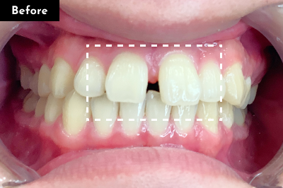 すきっ歯治療前 - Oh my teeth マウスピース矯正Basicプラン症例 Case 32